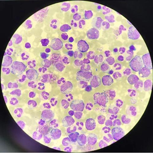 一文了解“慢性粒细胞白血病”治疗的奇迹历程