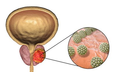 诺华放射配体疗法双适应症在华获批，前列腺癌治疗进入"