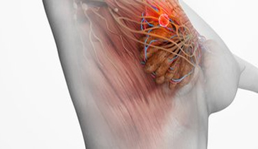 乳腺癌骨转移阻击战打响！60%晚期患者需警惕，防治新策略出炉
